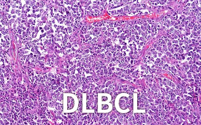 car-t疗法的治愈率是多少,car-t治愈率有多大