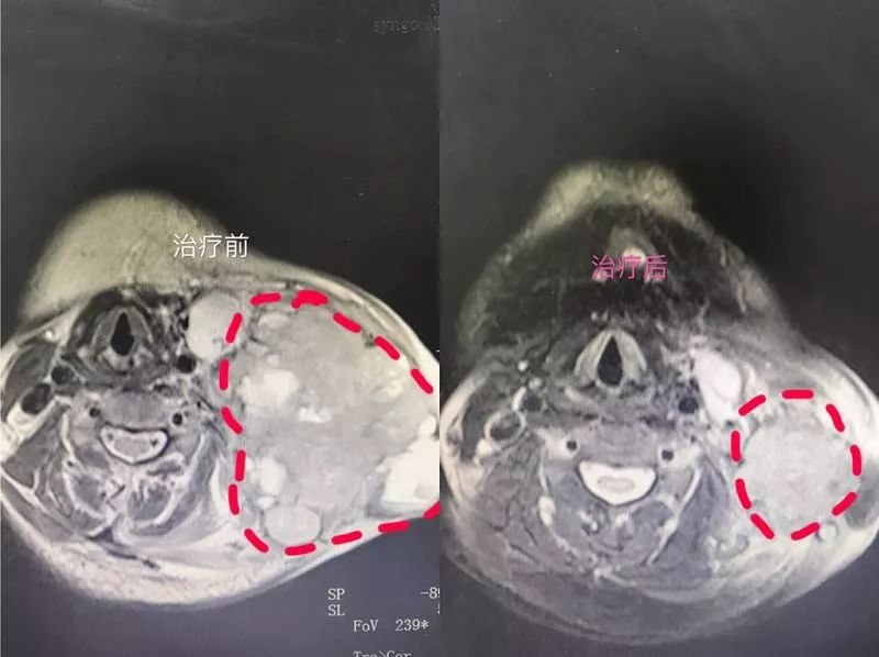 鼻咽癌脖子肿瘤太大还能治好吗,鼻咽癌转移颈部淋巴能彻底治好吗