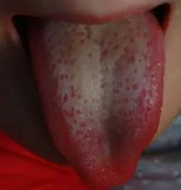 通过舌诊看儿童健康,小儿舌诊临床案例