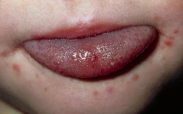 夏季手足口病的预防小知识,手足口水痘注意事项