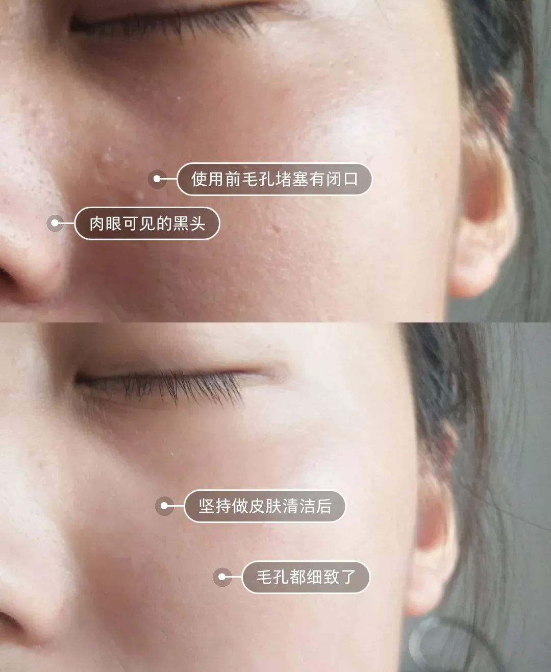 拯救毛孔黑头,清除黑头大毛孔的利器