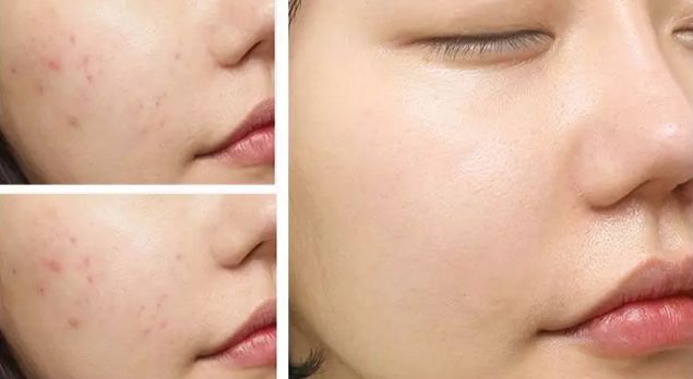 1分钱祛痘神器,祛痘神器0元领取