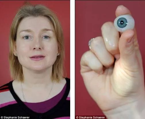 戴隐形眼镜导致角膜内皮细胞减少,因为戴隐形眼镜眼睛肿了