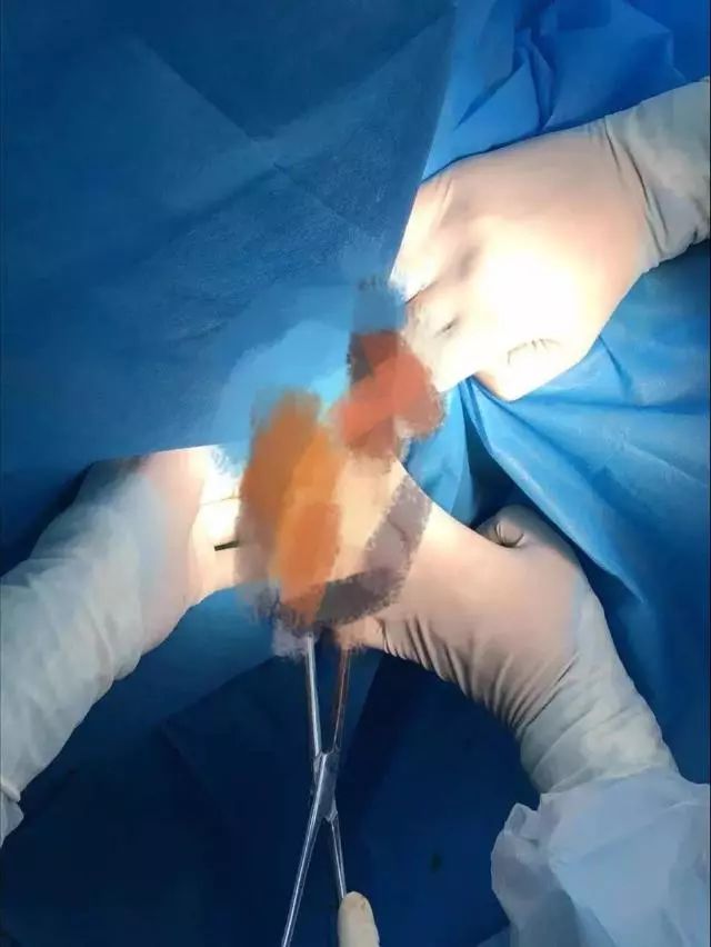 菊花一紧！男子洗澡摔倒，面霜棒插入肛门！进去容易出来难…