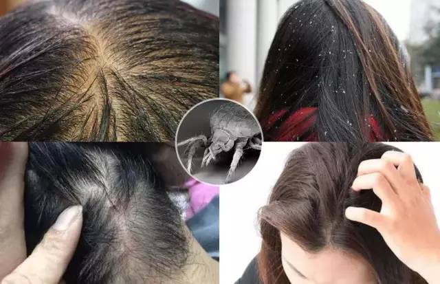 头皮发痒爱出油是什么引起的,头皮出油严重痒是什么原因引起的