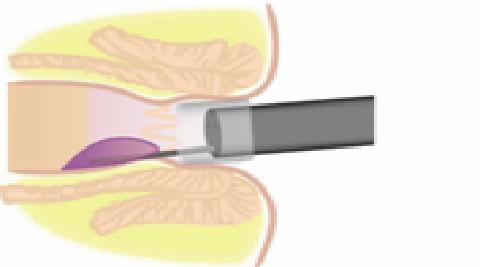 滨州肛肠医院治痔疮,滨州市哪家医院治疗痔疮比较权威