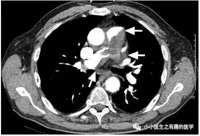 肺动脉分支充盈欠佳是肺栓塞吗,肺动脉缺损不可逆