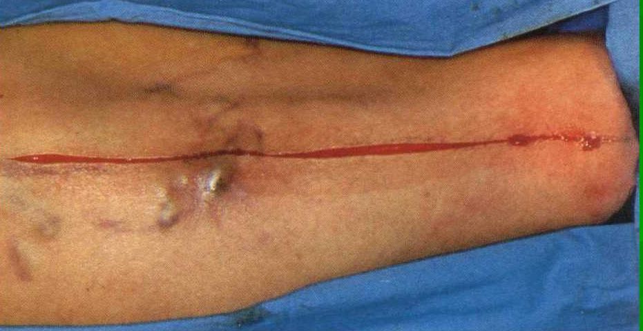 筋疙瘩的图片大全,筋疙瘩的危害