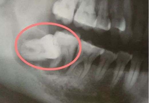 拔智齿为什么要用骨劈开术,智齿只剩牙根拔智齿的全过程