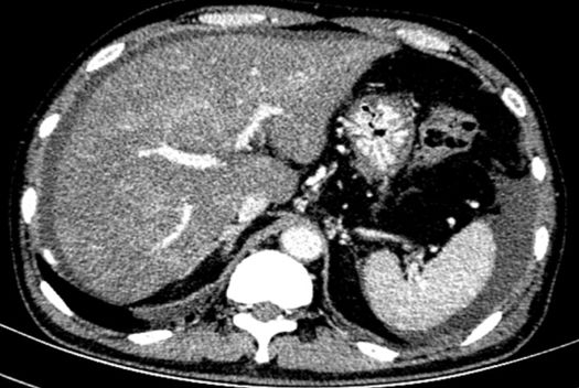 土三七中毒治好后肝能恢复正常吗,土三七中毒所致的肝损害的治疗