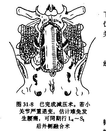 一分钟带你了解腰椎狭窄,椎管狭窄症知识大全