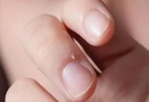 一个没注意，手指倒刺变截指！