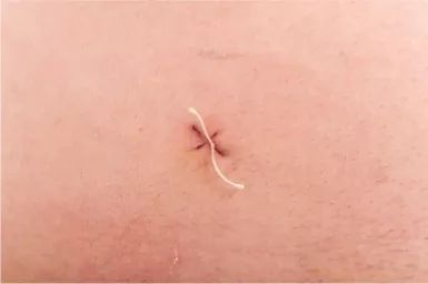 腹腔镜微创手术3d显示技术,3d腹腔镜和超高清腹腔镜