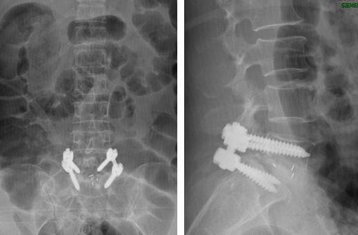 腰椎滑脱怎样做有氧康复训练,腰椎滑脱康复治疗预后