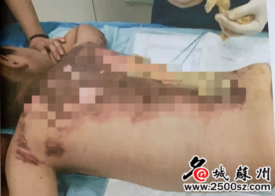 3岁儿子在家无意打翻开水被烫伤,儿子被开水烫伤妈妈送医院