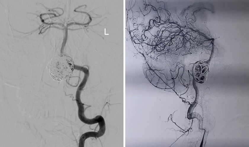 椎动脉夹层动脉瘤的最佳治疗方法,椎基底动脉夹层动脉瘤治疗方法
