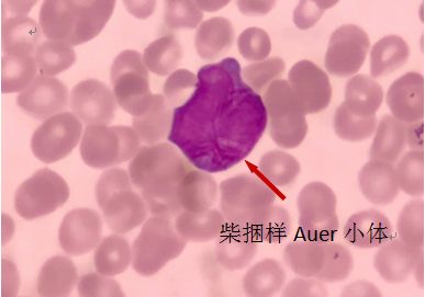 外周血细胞形态分析能查出什么病,外周血细胞形态能看出白血病吗