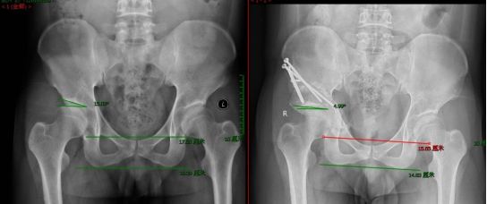 股骨头坏死保髋手术能撑几年,股骨头坏死的保髋治疗