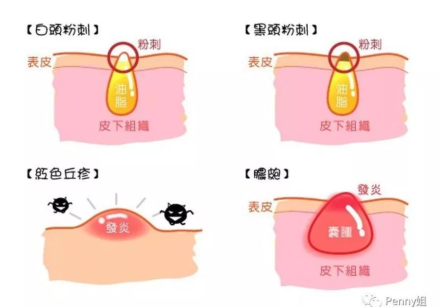 那些年一起挤过的痘痘,那些年我们一起倒过的垃圾