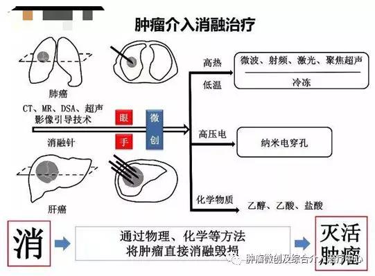 咯血介入治疗后还要止血药吗,肺部大咯血的介入栓塞治疗