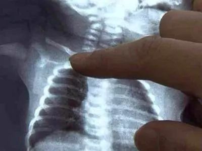 小孩锁骨骨折赔偿价目表,新生婴儿锁骨骨折怎么办