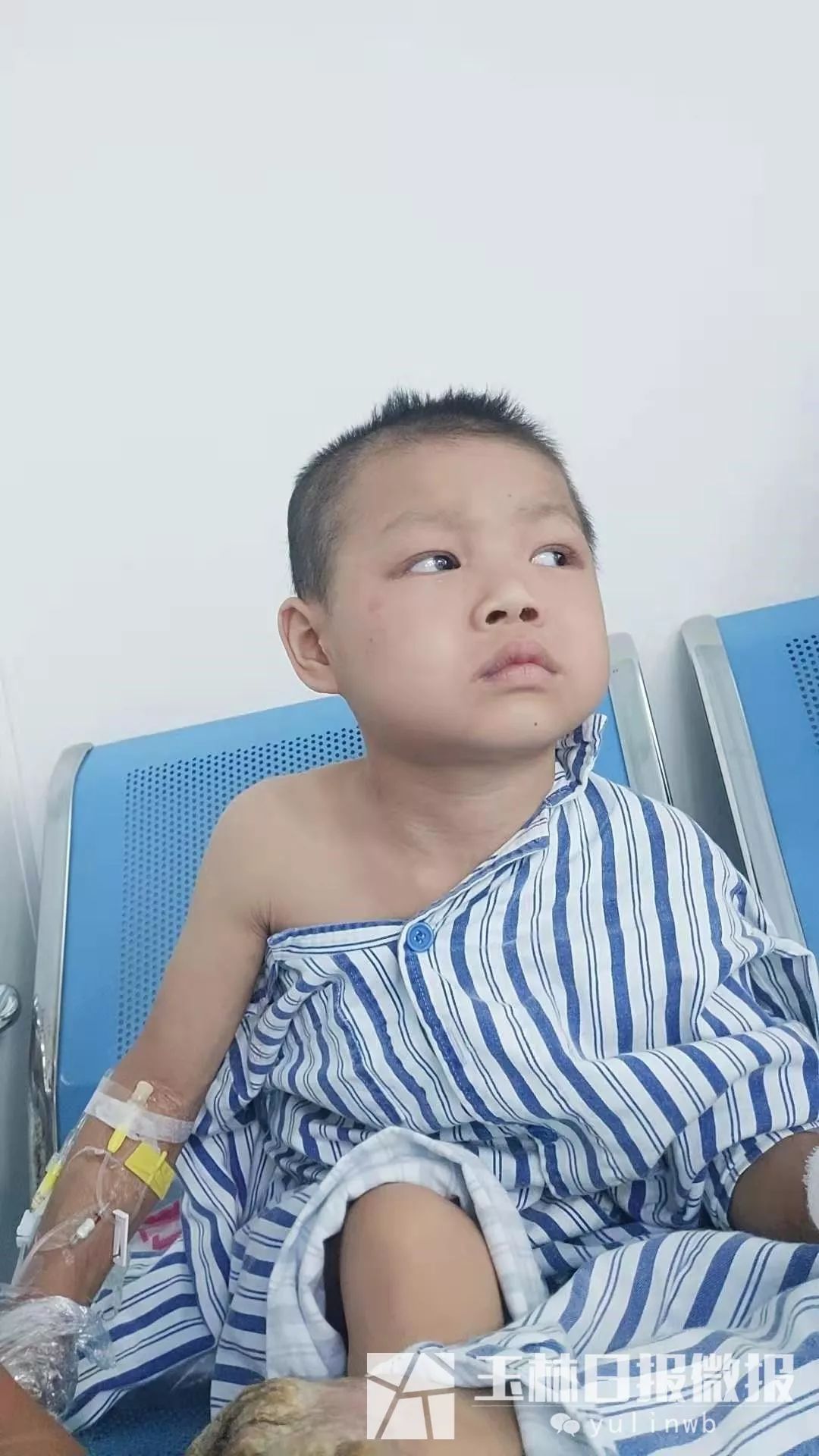 容县太和村小男孩硬皮病治好没有,容县树皮男孩后续