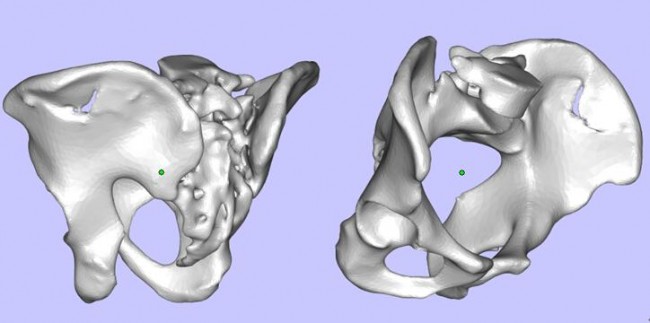 攀枝花三帝科技：3D打印助力髋关节患者骨盆修复