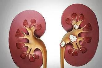 郝大夫,患上肾结石该怎么办?