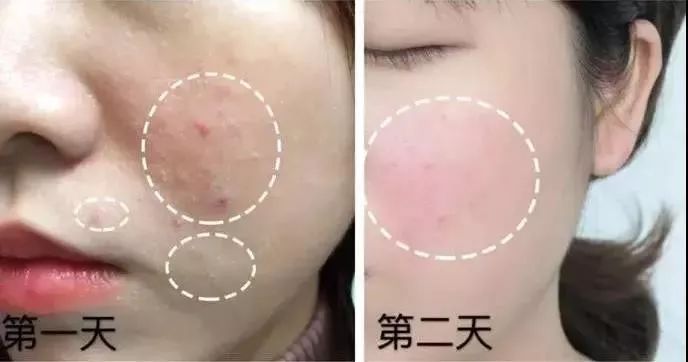1分钱祛痘神器,祛痘神器0元领取
