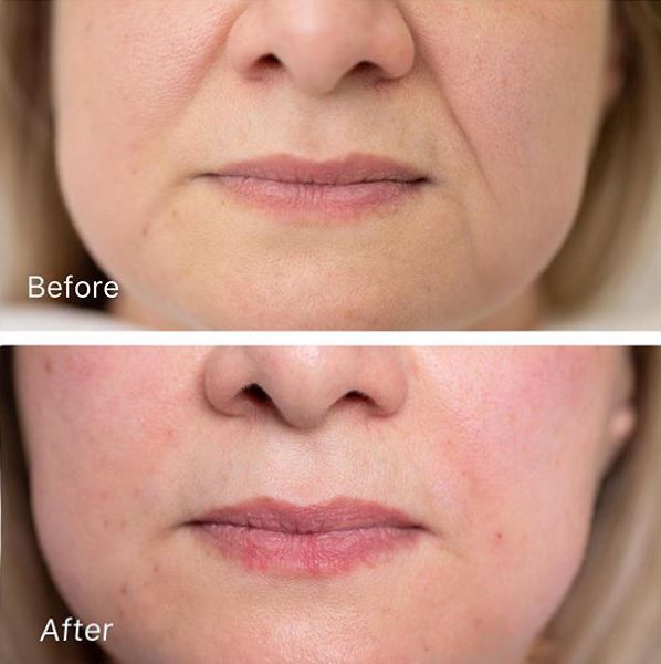 眉间纹和法令纹除皱针能去掉吗,嘴角纹法令纹抬头纹国货推荐