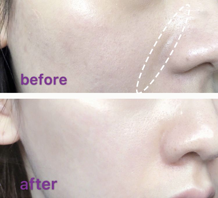 法令纹又黑又长,法令纹又深又长好吗