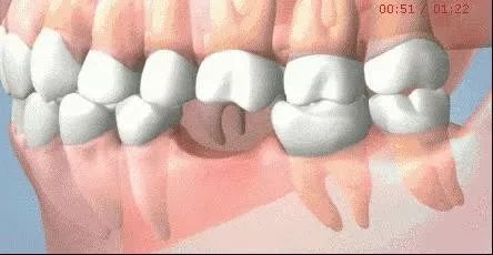 2023年天津种牙能纳入医保吗,天津人有没有什么优惠政策