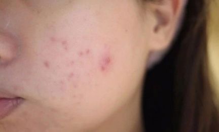 长痘不能吃什么辣的食品,长痘忌口辛辣食物有哪些