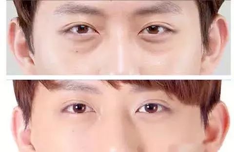 眼袋松弛下垂最快解决方法,严重眼袋下垂松弛怎么恢复