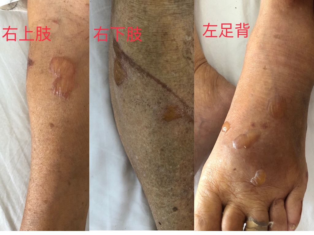 长水泡是什么前兆,一般长水泡的原因是什么