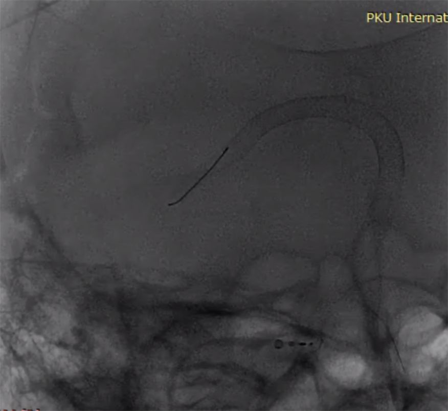 物华天宝·第7期｜脑部长型巨大夹层动脉瘤的4个密网支架桥接治疗复查治愈（附复查CTA结果）