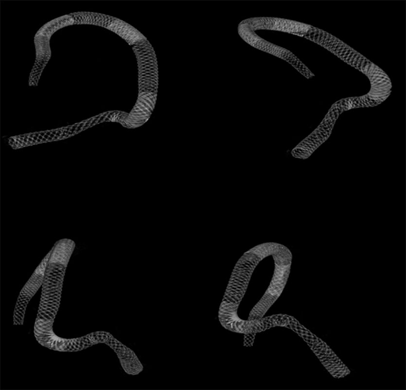 物华天宝·第7期｜脑部长型巨大夹层动脉瘤的4个密网支架桥接治疗复查治愈（附复查CTA结果）