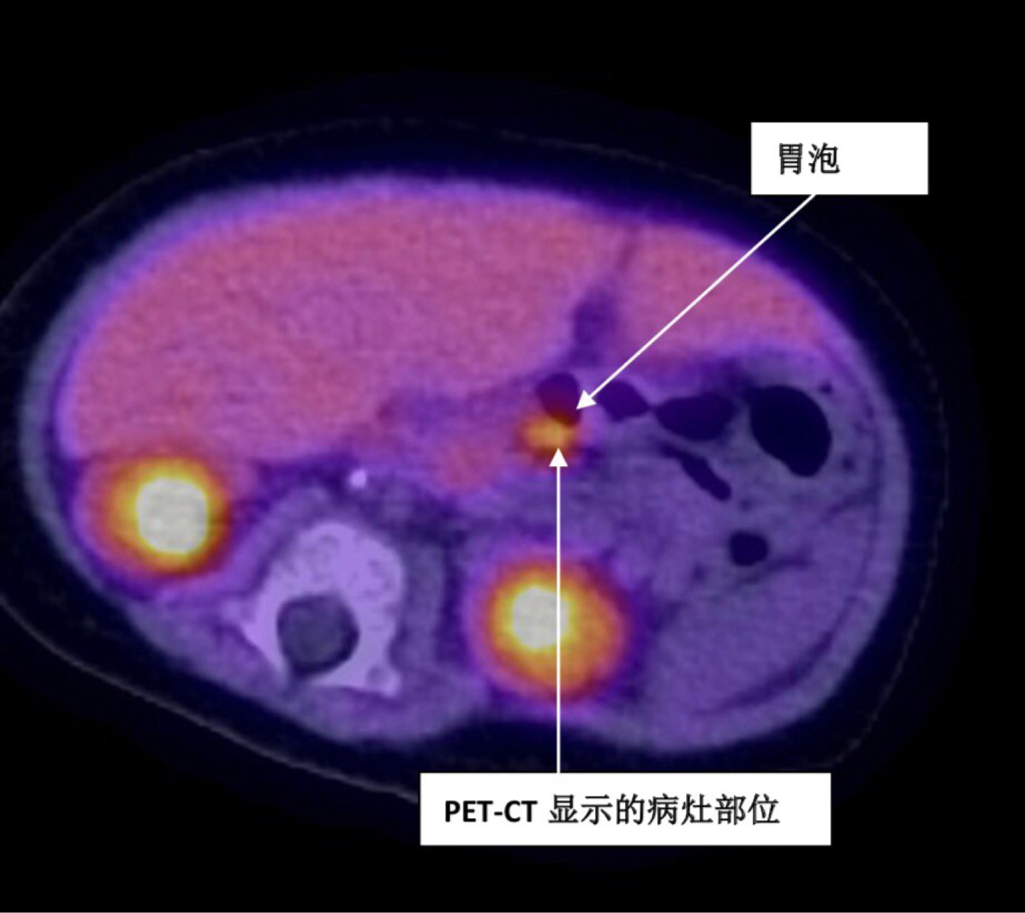 罕见，胰腺长在胃上！一先天性高胰岛素血症婴儿在上海获救