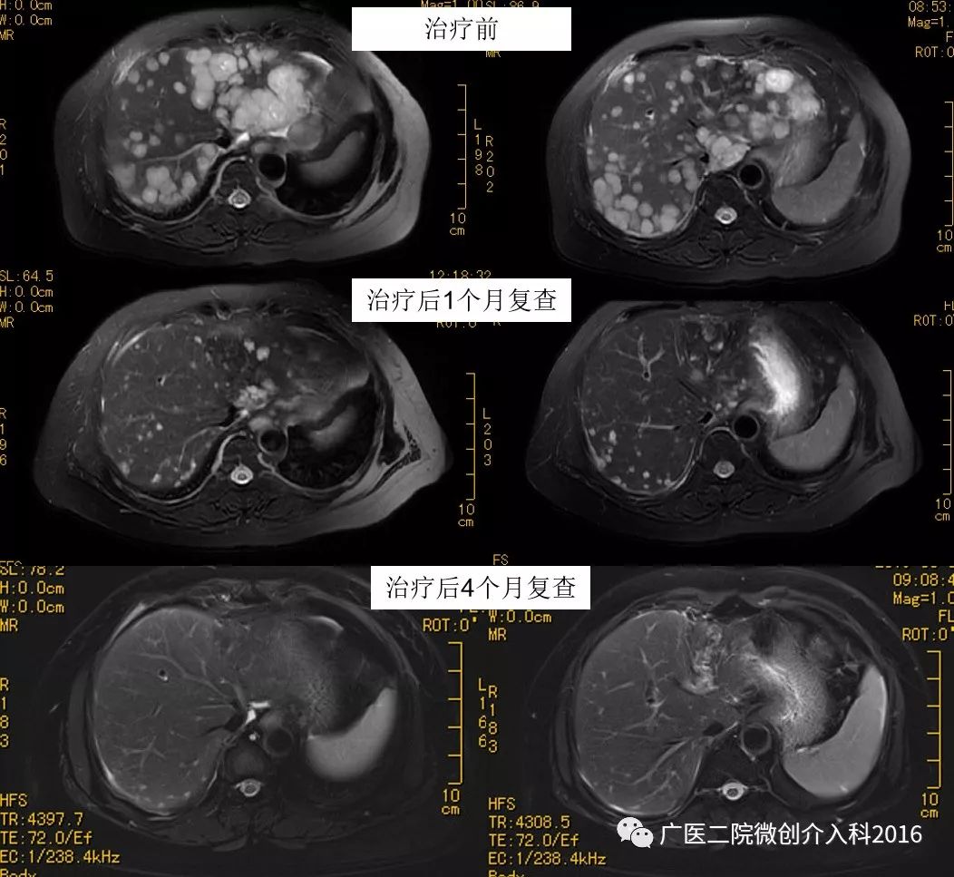 精准介入治疗效果好吗,精准免疫治疗最新消息