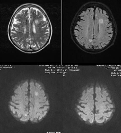 Rasmussen脑炎、结核性肉芽肿、脑发育性静脉畸形丨3分钟读片·第13期,下)