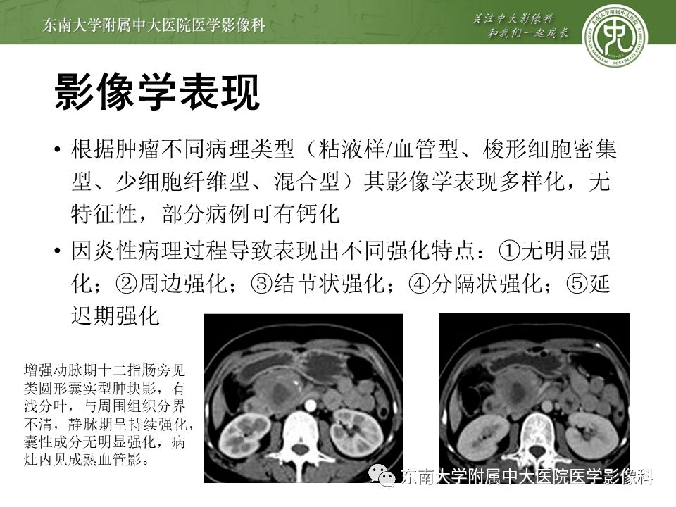 侵袭性纤维瘤影像学表现,侵袭性纤维瘤病影像上易诊断吗