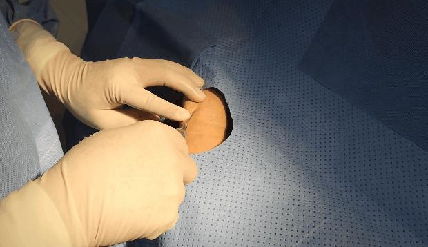 心脏造影和支架一起做大概多少钱,心脏造影支架视频全过程