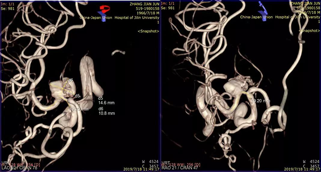 治疗颅内动脉瘤新型密网支架,密网支架处理动脉瘤的风险