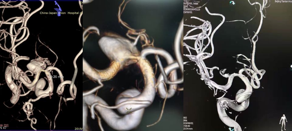 治疗颅内动脉瘤新型密网支架,pipeline治疗椎动脉夹层动脉瘤