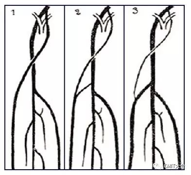 冠脉造影技术成熟不,跟我学技术分析从入门到精通