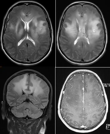 平山病、MELAS、MVNT、ODS丨3分钟读片·第15期
