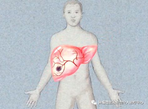 运城市第一医院介入科特色技术——肿瘤的化疗栓塞术