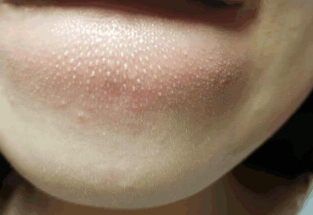 下巴上的螨虫用什么护肤品去除,下巴长螨虫有什么症状