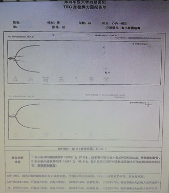 缺血性心肌病心衰恢复,缺血性心衰能逆转吗