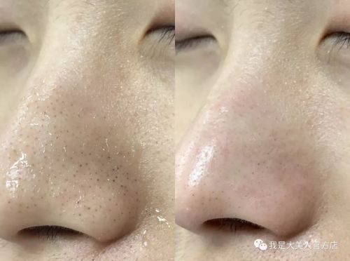 画面极度舒适！十几年顽固老黑头，30秒彻底连根拔起！毛孔畅快呼吸原来是这种感觉